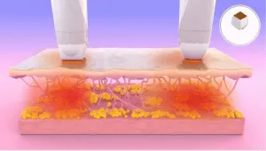 電波拉皮